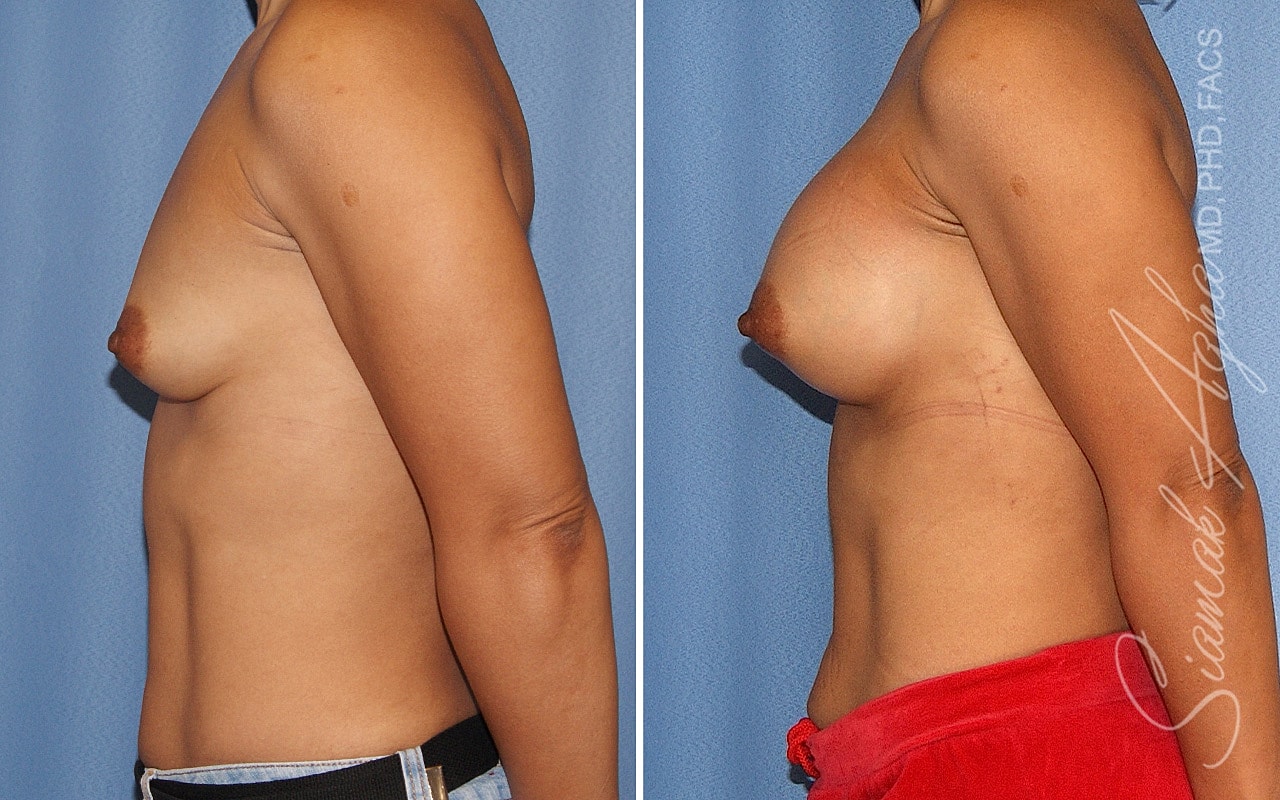 Breast Augmentation Before & After