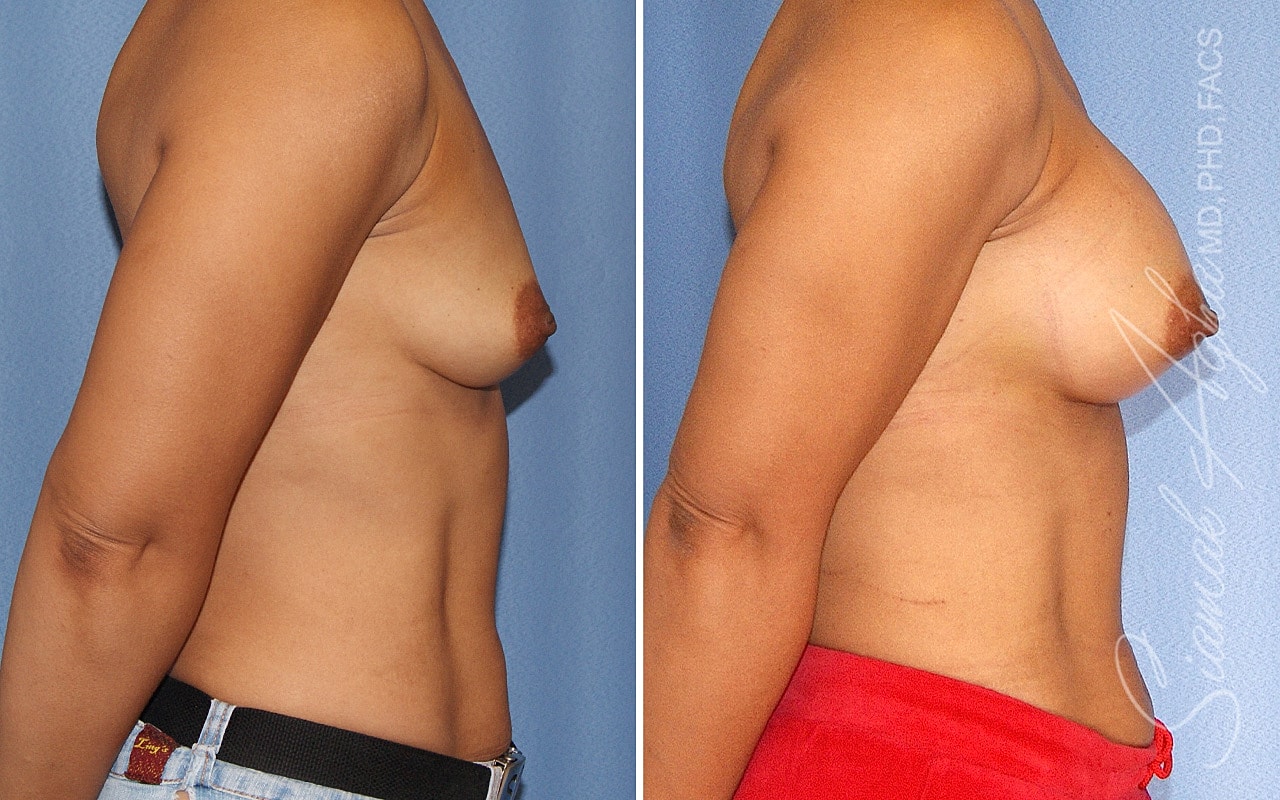 Breast Augmentation Before & After