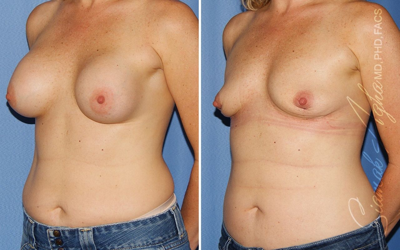 Breast Implant Removal Before & After