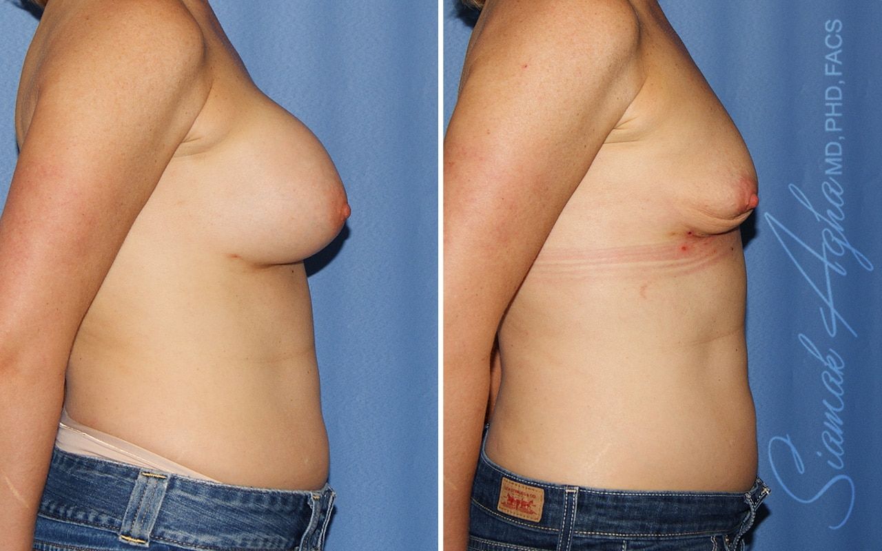 Breast Implant Removal Before & After