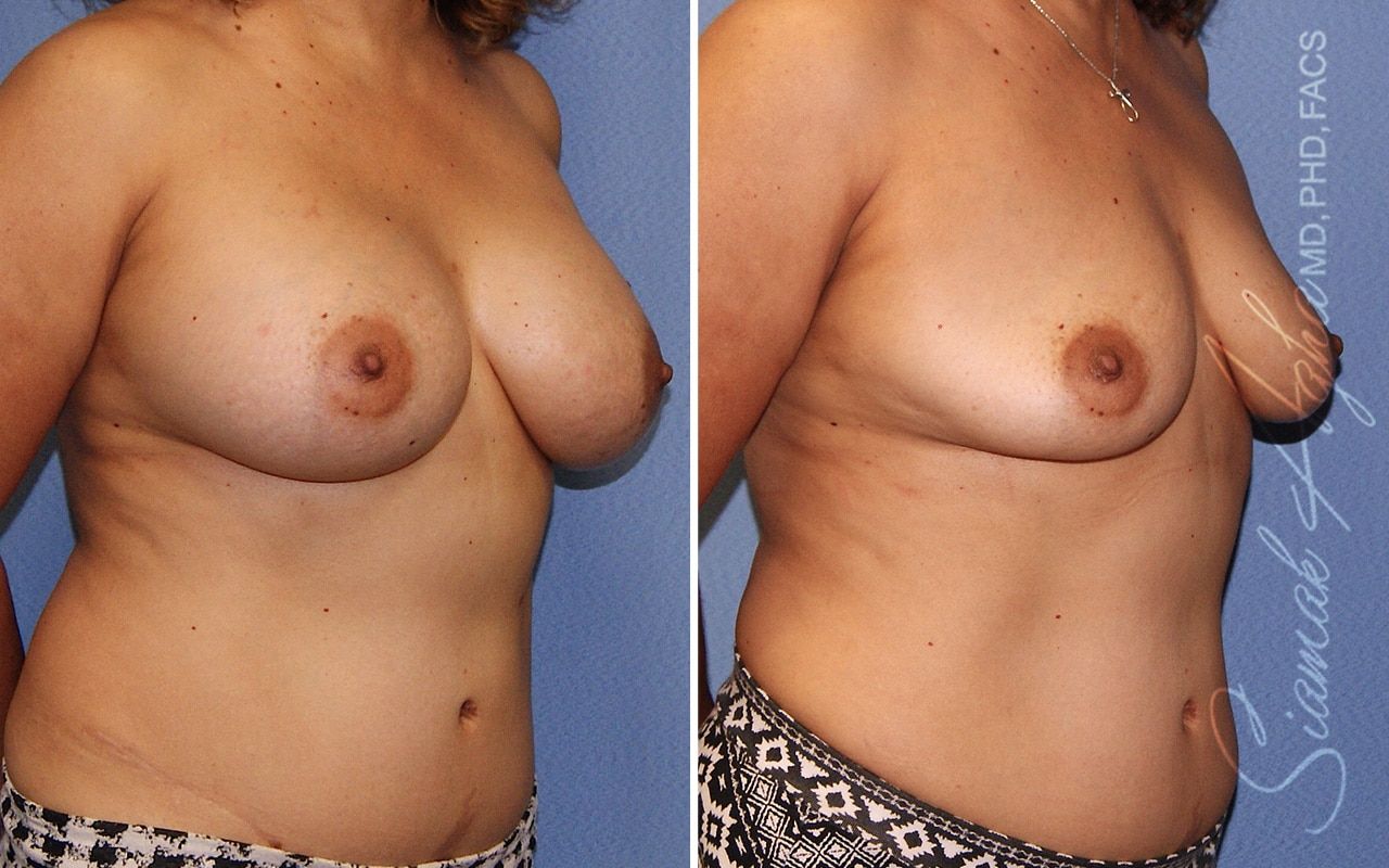 Breast Implant Removal Before & After