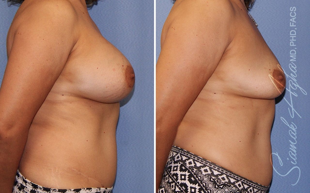 Breast Implant Removal Before & After