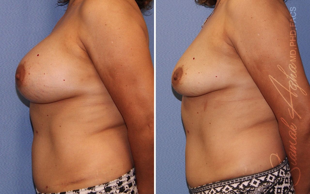 Breast Implant Removal Before & After