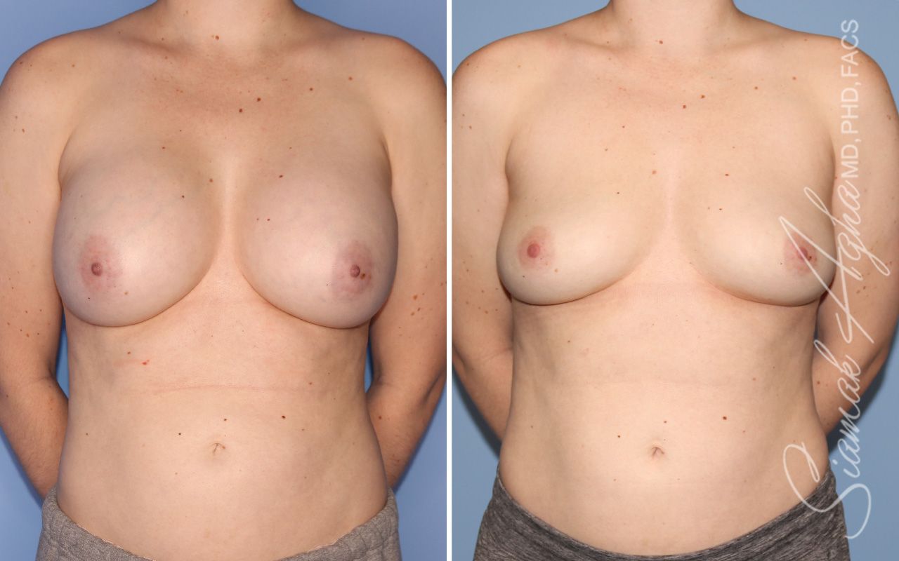 Breast Implant Removal Before & After