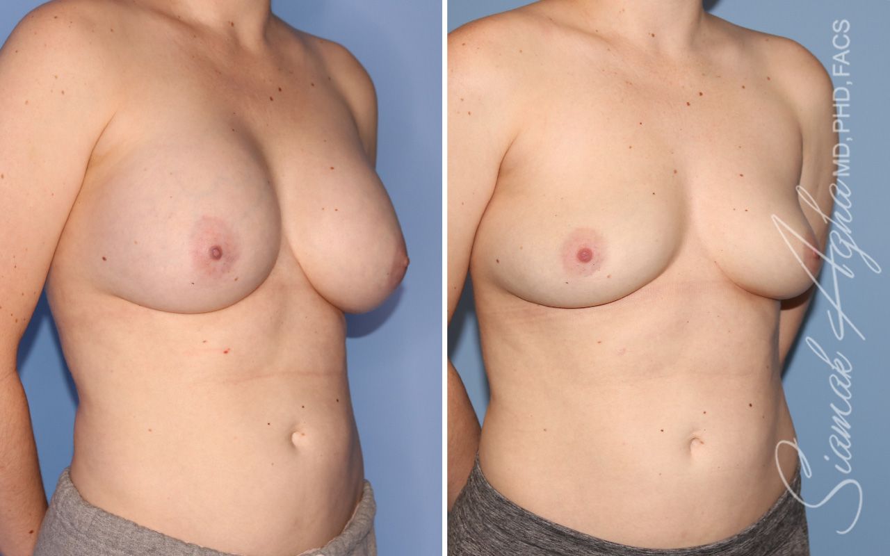 Breast Implant Removal Before & After