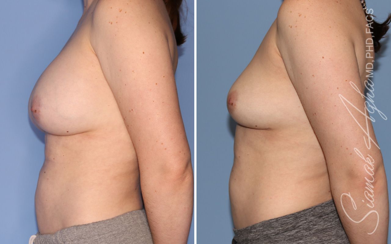 Breast Implant Removal Before & After
