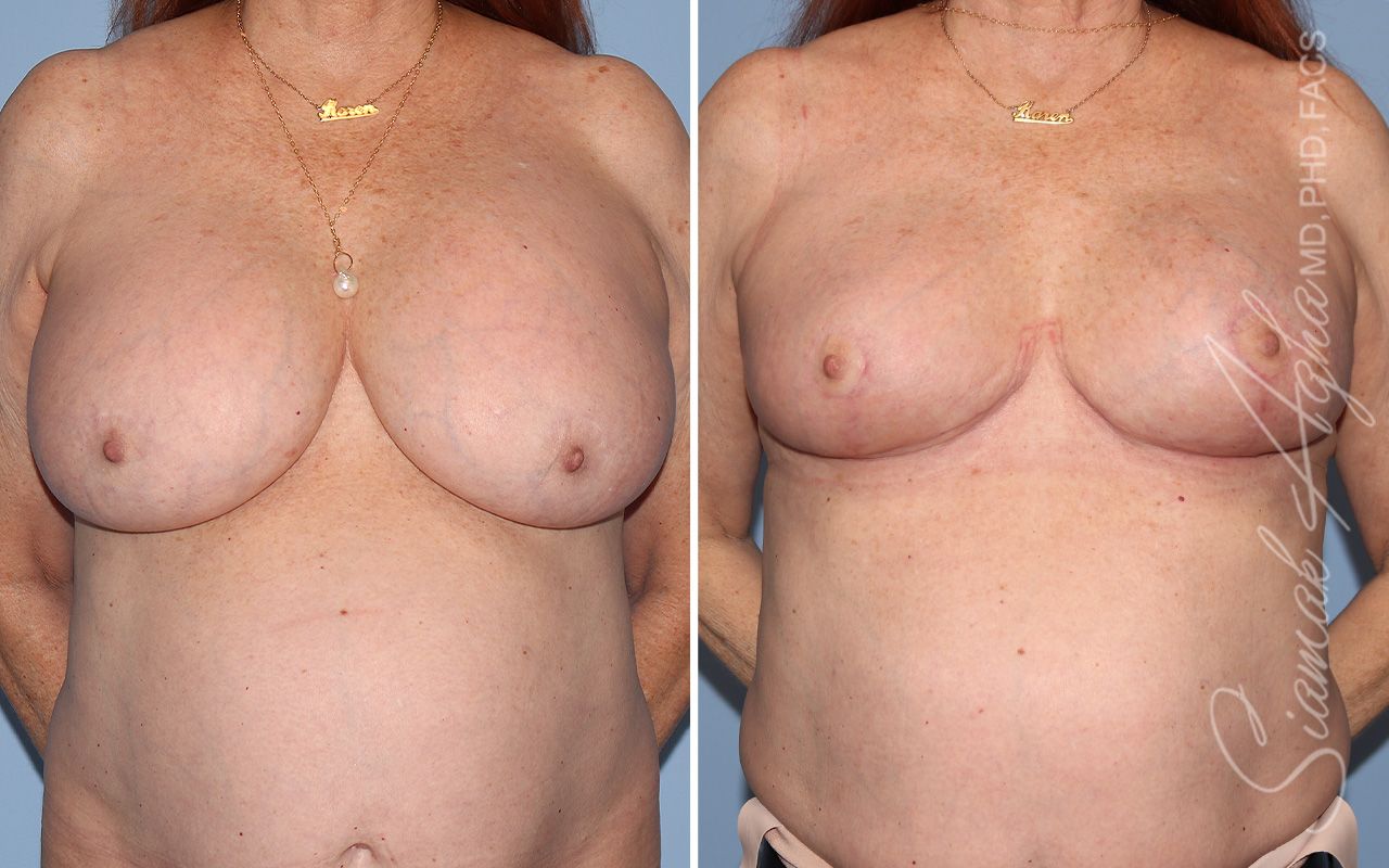 Breast Implant Removal Before & After