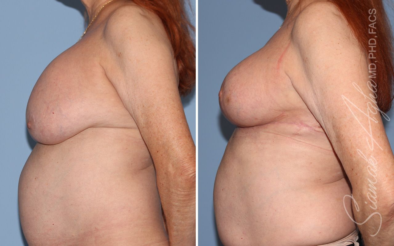 Breast Implant Removal Before & After