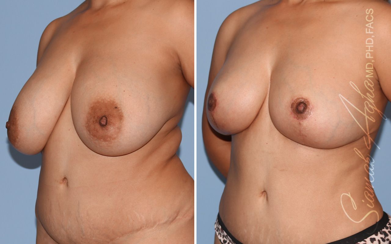 Breast Implant Removal Before & After