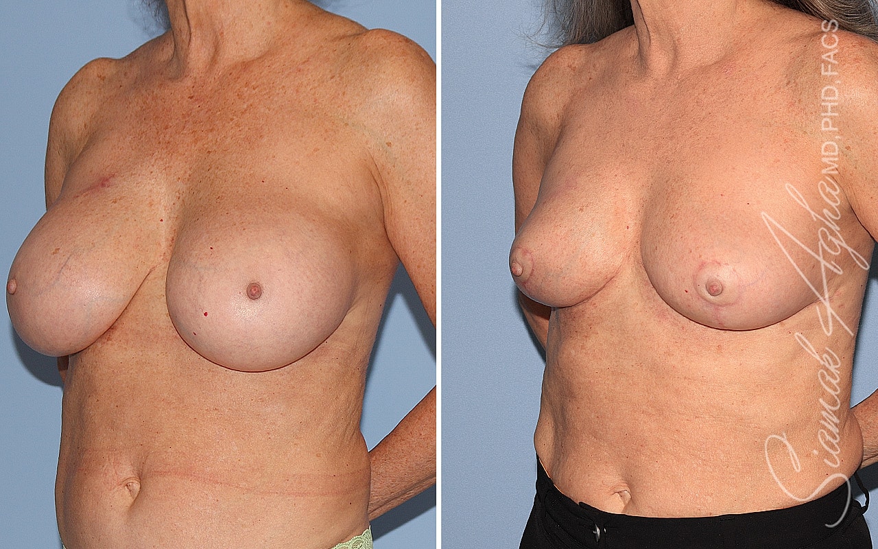 Breast Implant Removal Before & After