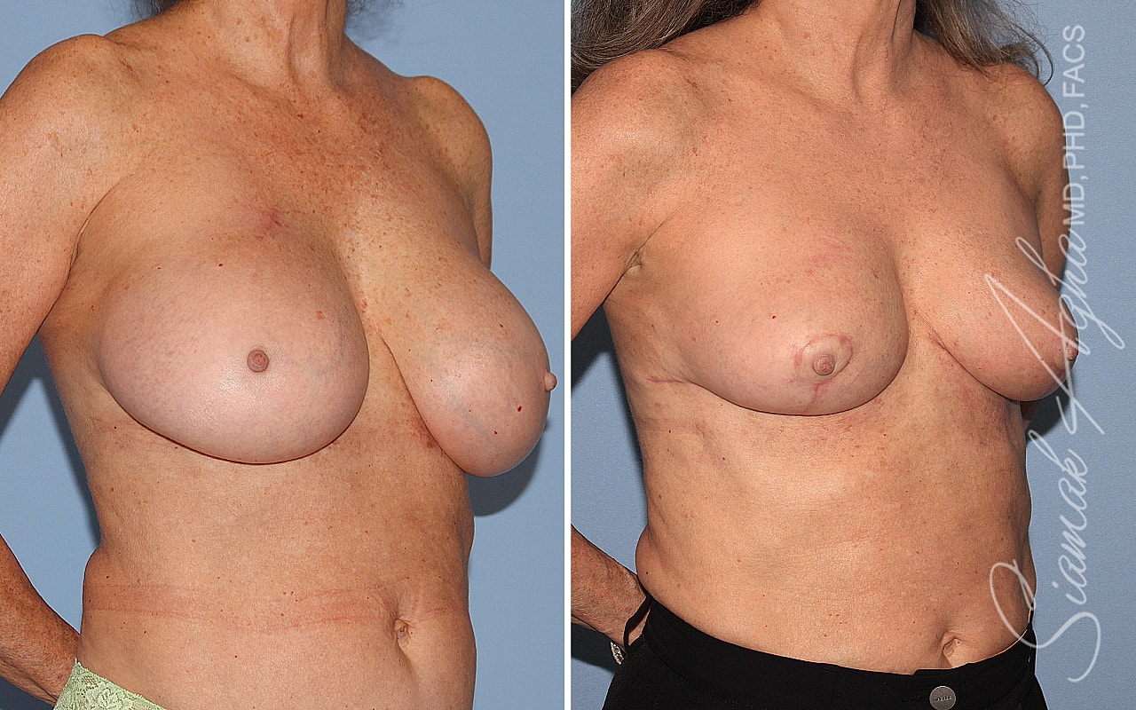 Breast Implant Removal Before & After