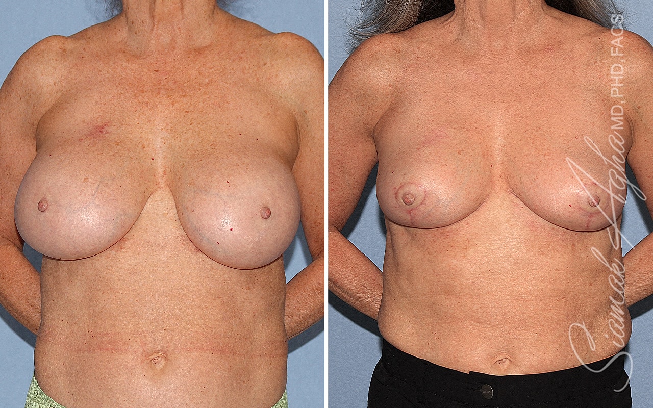 Breast Implant Removal Before & After