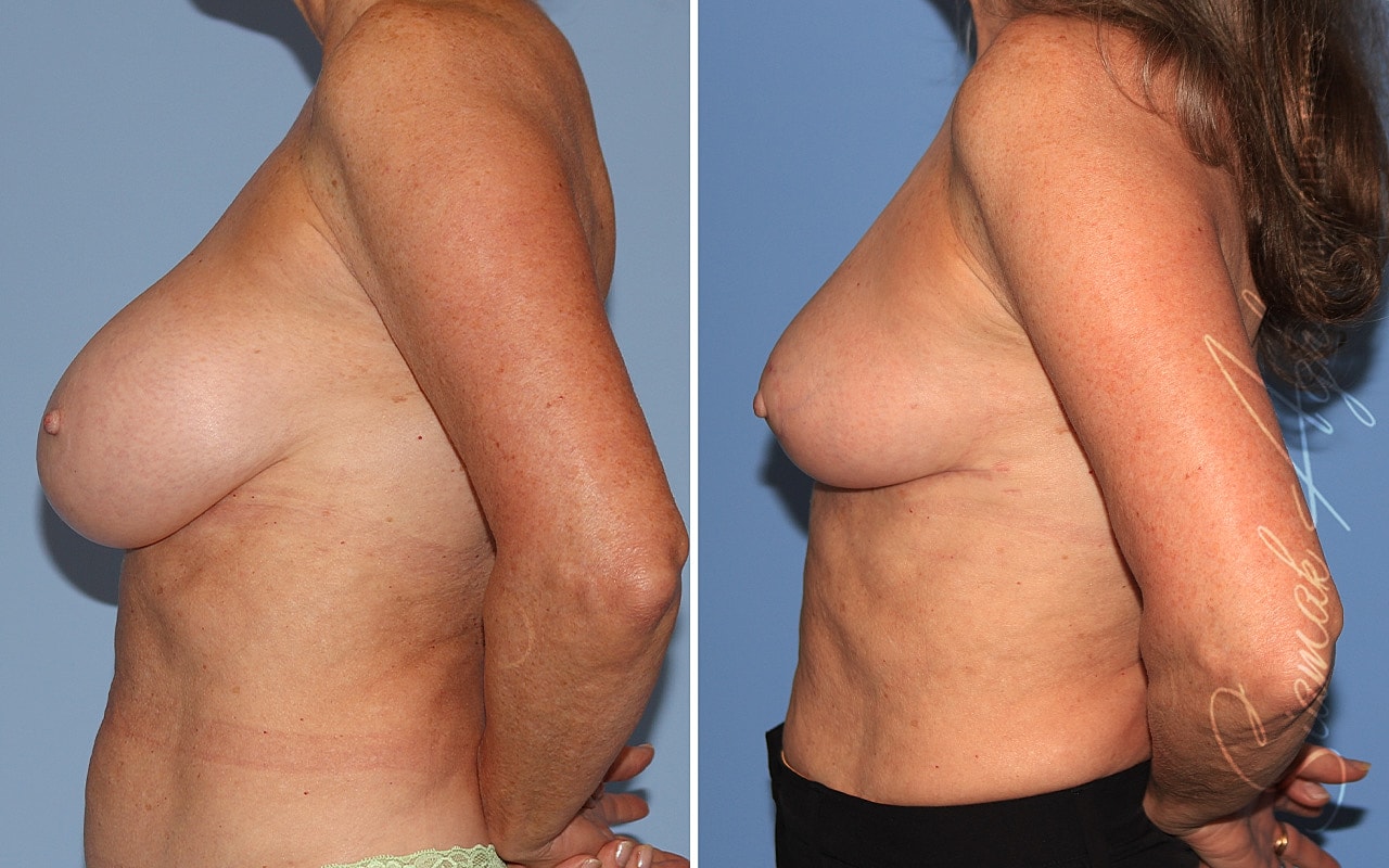 Breast Implant Removal Before & After