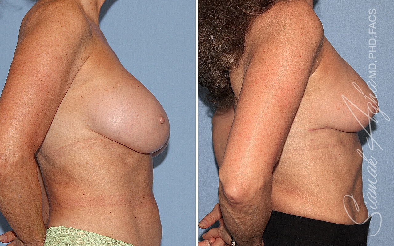 Breast Implant Removal Before & After