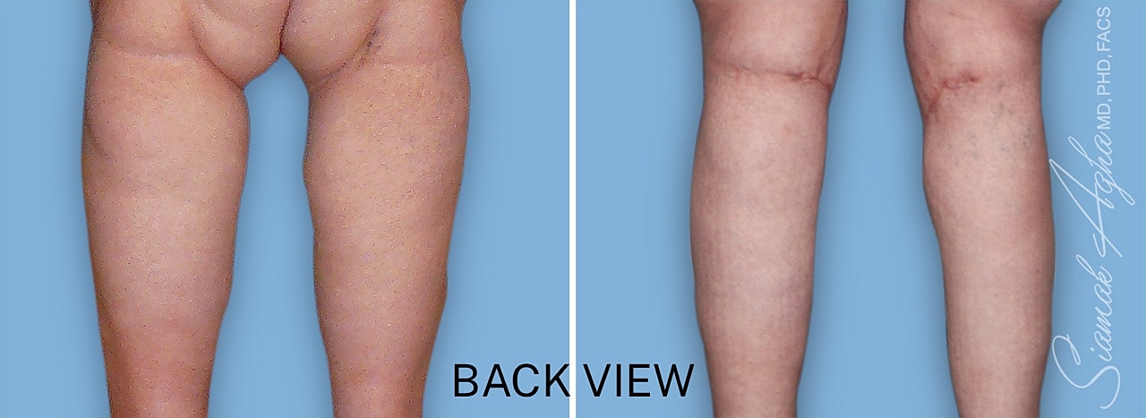Calf reduction surgery before and after back view