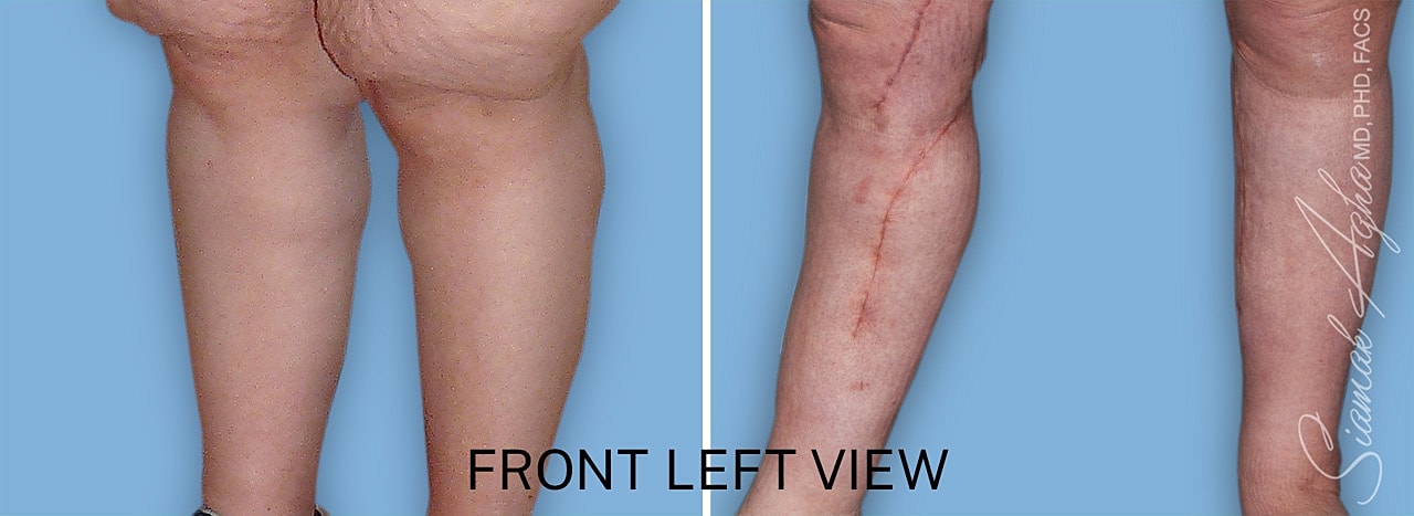 Calf reduction surgery before and after front left view