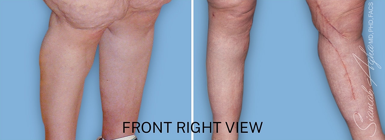 Calf reduction surgery before and after front right view