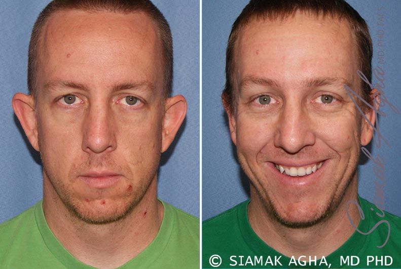 Otoplasty Before & After