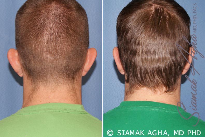 Otoplasty Before & After