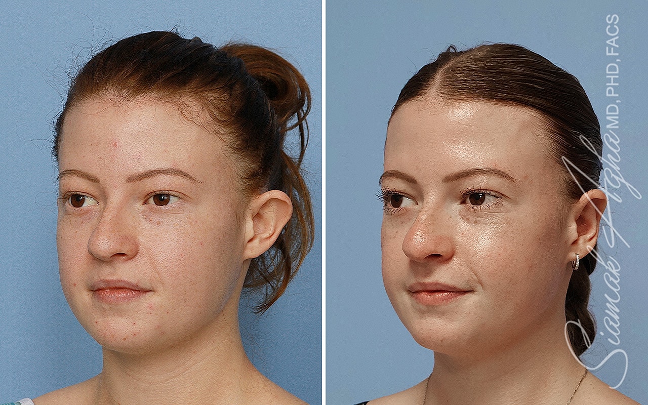 Otoplasty Before & After