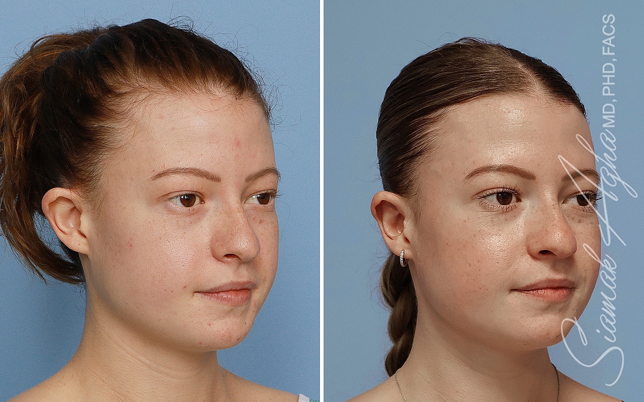 Otoplasty Before & After