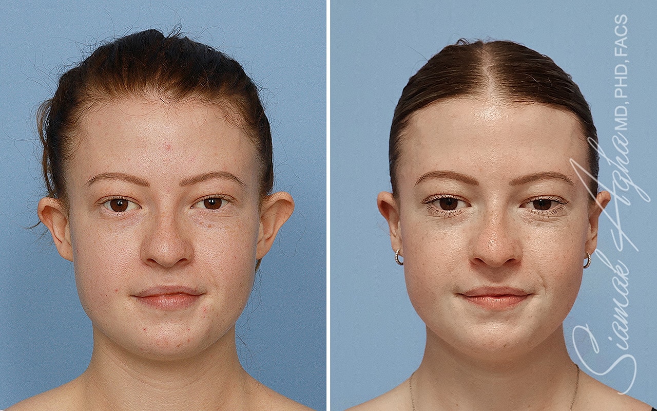 Otoplasty Before & After