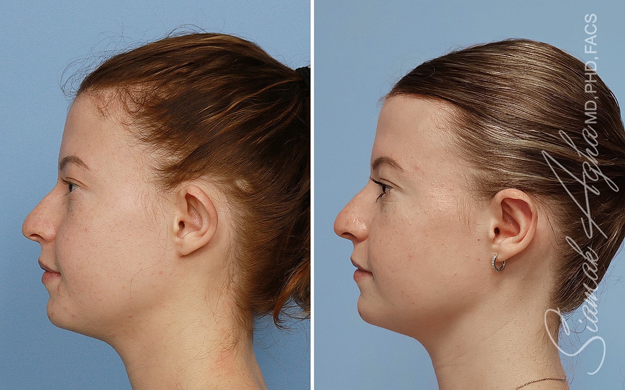 Otoplasty Before & After