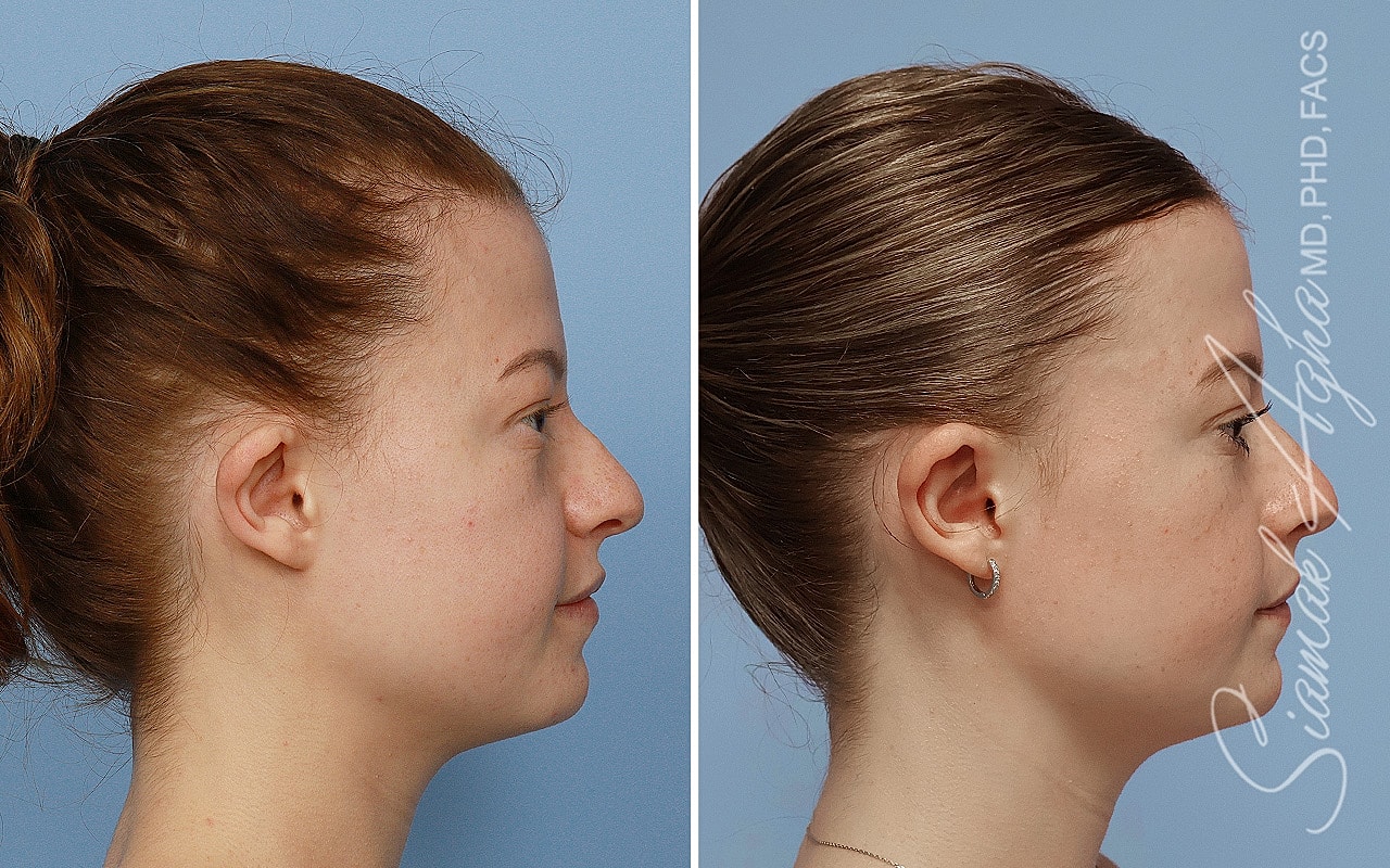 Otoplasty Before & After