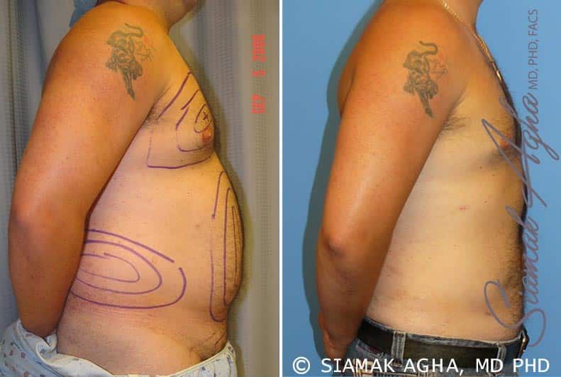Male Breast Reduction Before & After