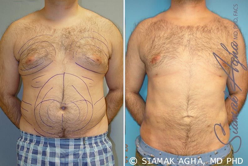 Male Breast Reduction Before & After