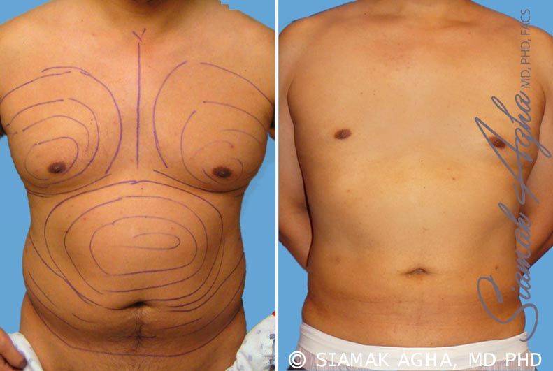 Male Breast Reduction Before & After