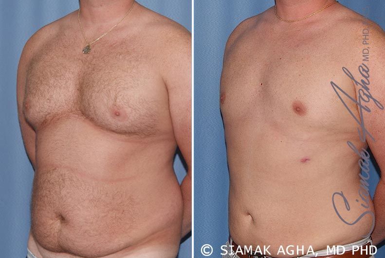 Male Breast Reduction Before & After