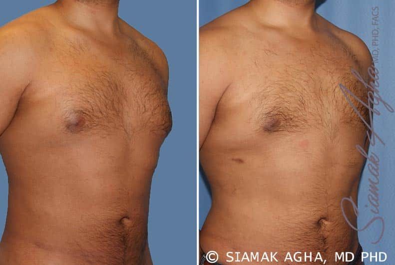 Male Breast Reduction Before & After
