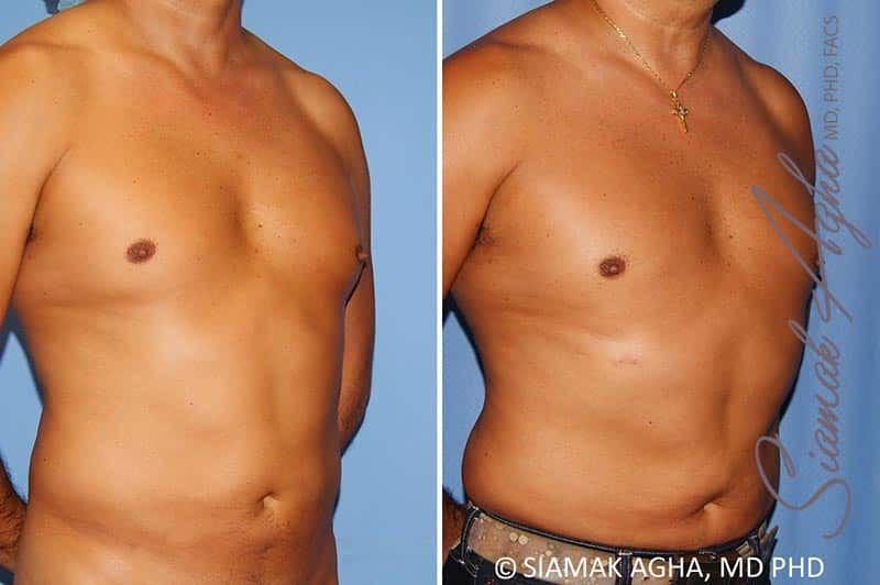 Male Breast Reduction Before & After