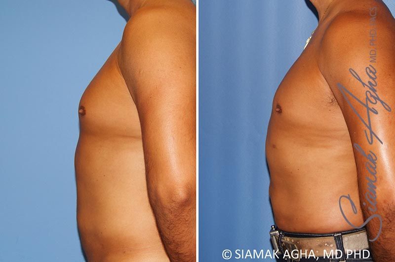 Male Breast Reduction Before & After