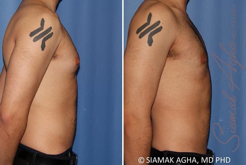Male Breast Reduction Before & After