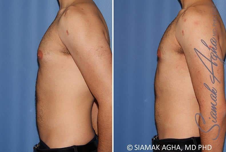 Male Breast Reduction Before & After