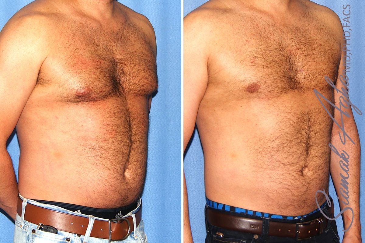 Male Breast Reduction Before & After