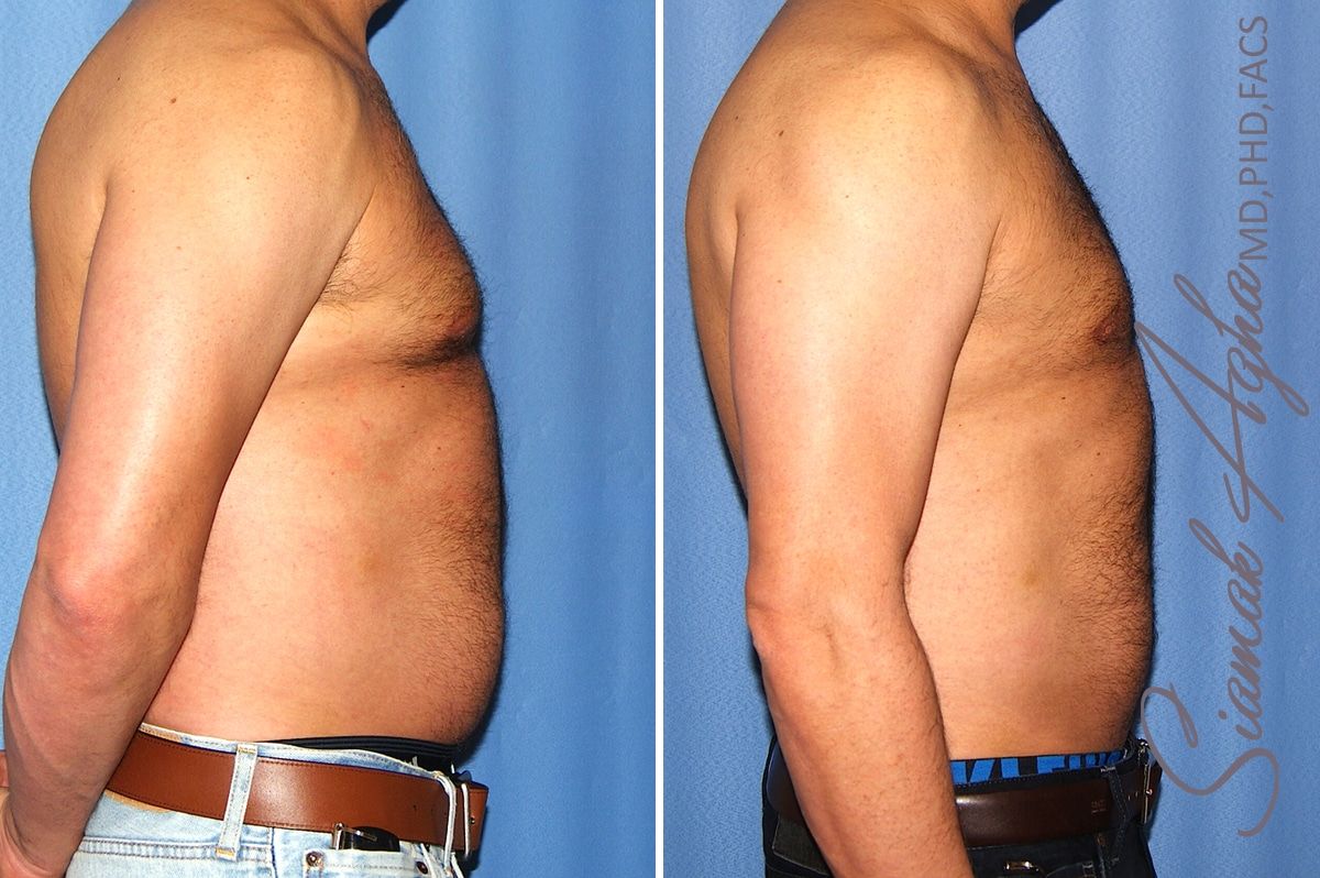 Male Breast Reduction Before & After