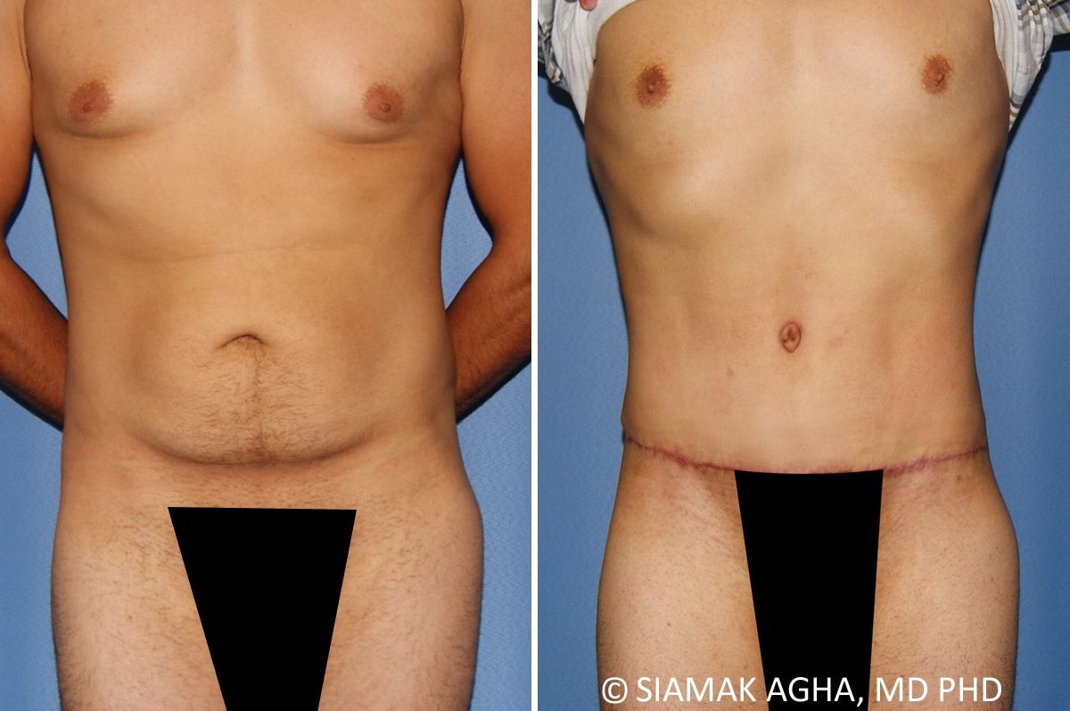 Male Breast Reduction Before & After