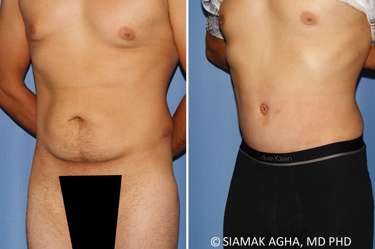 Male Breast Reduction Before & After