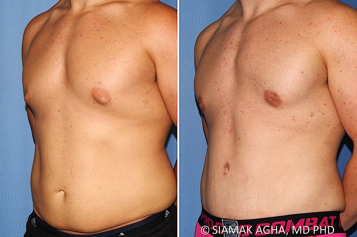 Male Breast Reduction Before & After