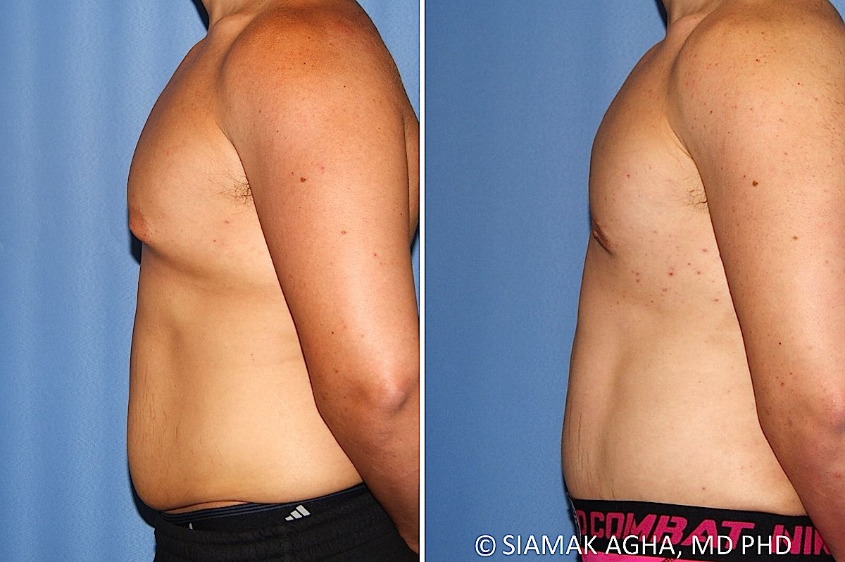 Male Breast Reduction Before & After