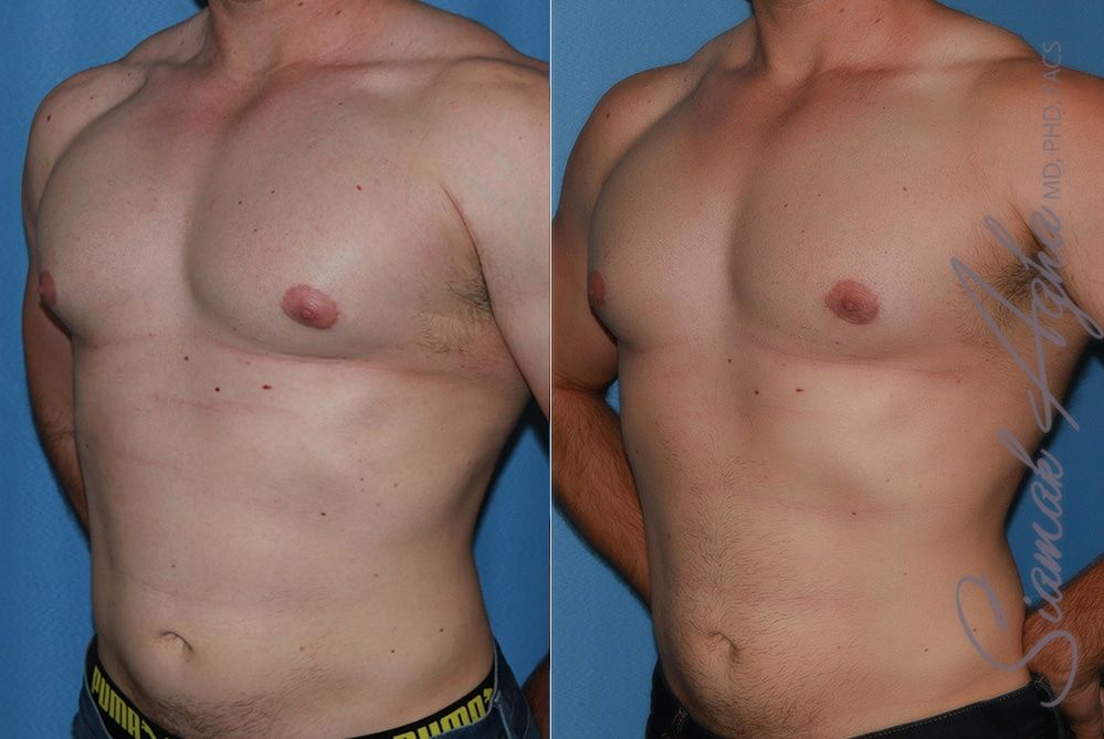 Male Breast Reduction Before & After