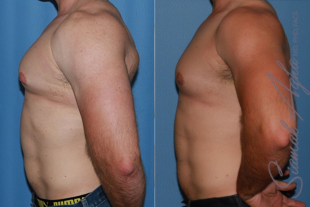 Male Breast Reduction Before & After