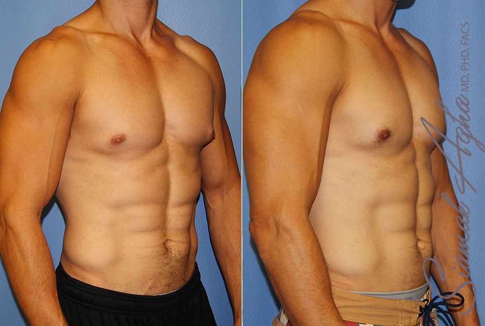 Male Breast Reduction Before & After