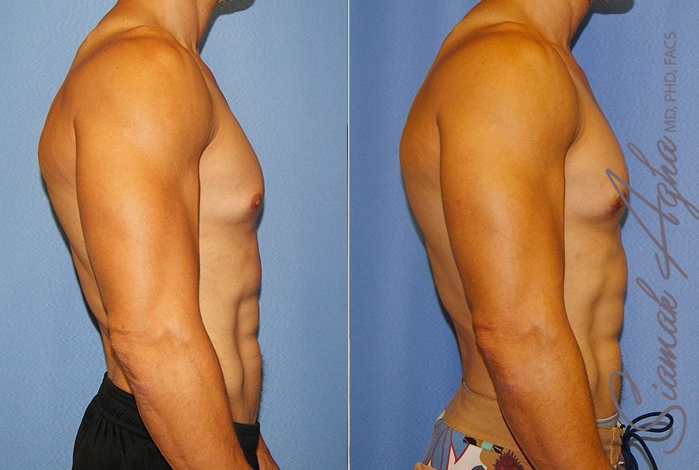 Male Breast Reduction Before & After