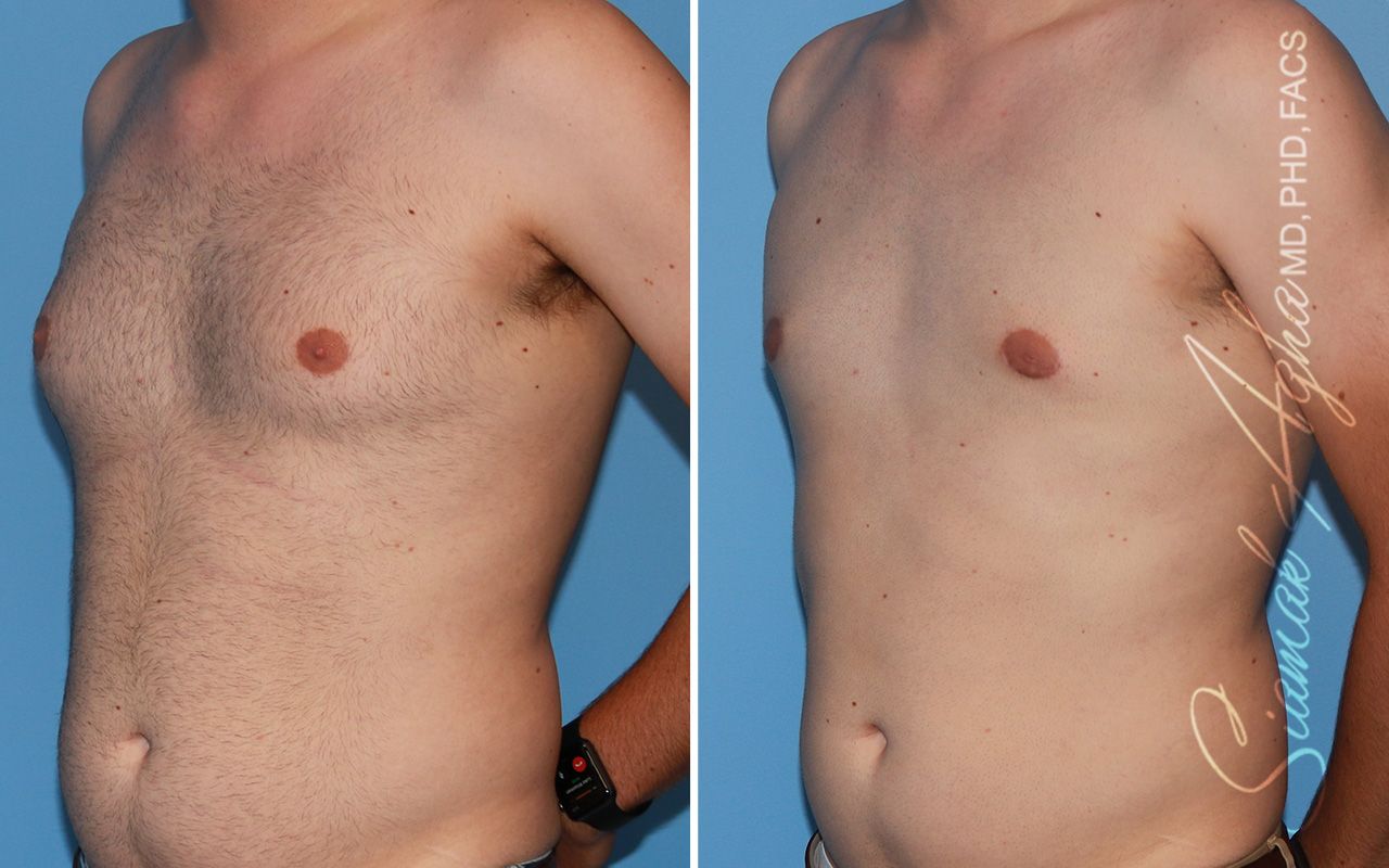 Male Breast Reduction Before & After