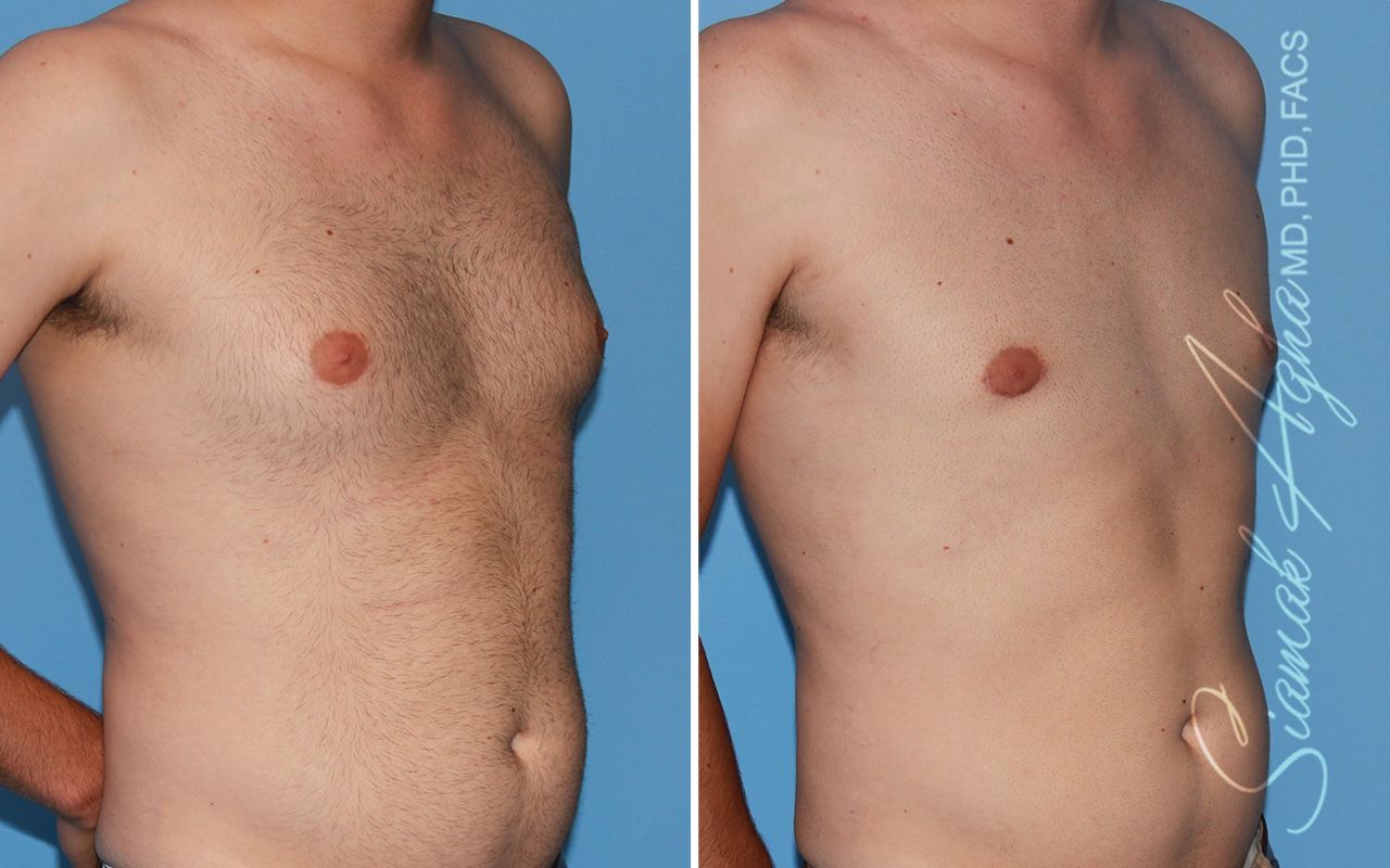 Male Breast Reduction Before & After
