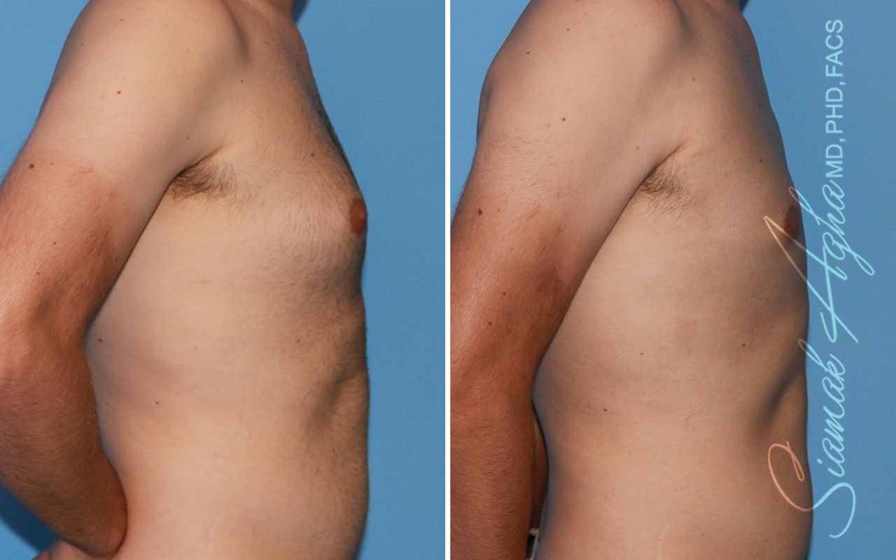 Male Breast Reduction Before & After